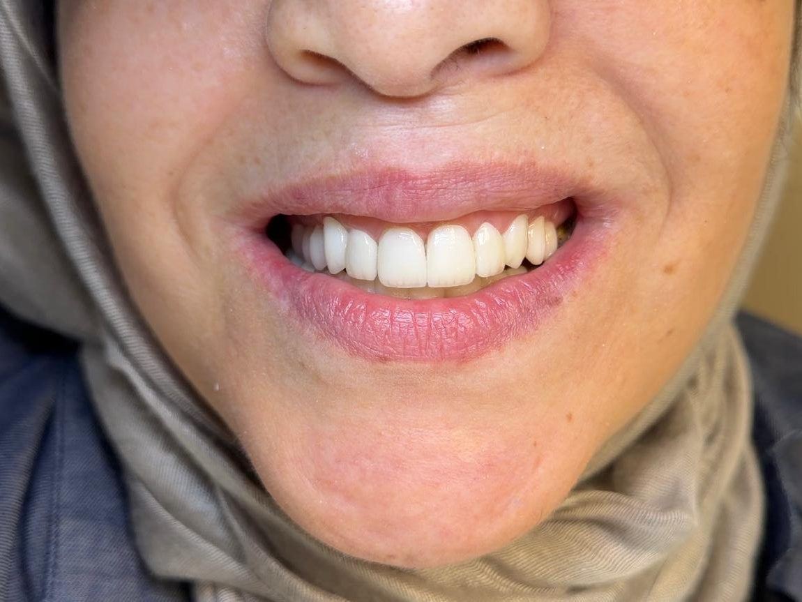 Facettes sur l'ensemble du sourire, après, Centre Dentaire El Attabi à Tétouan