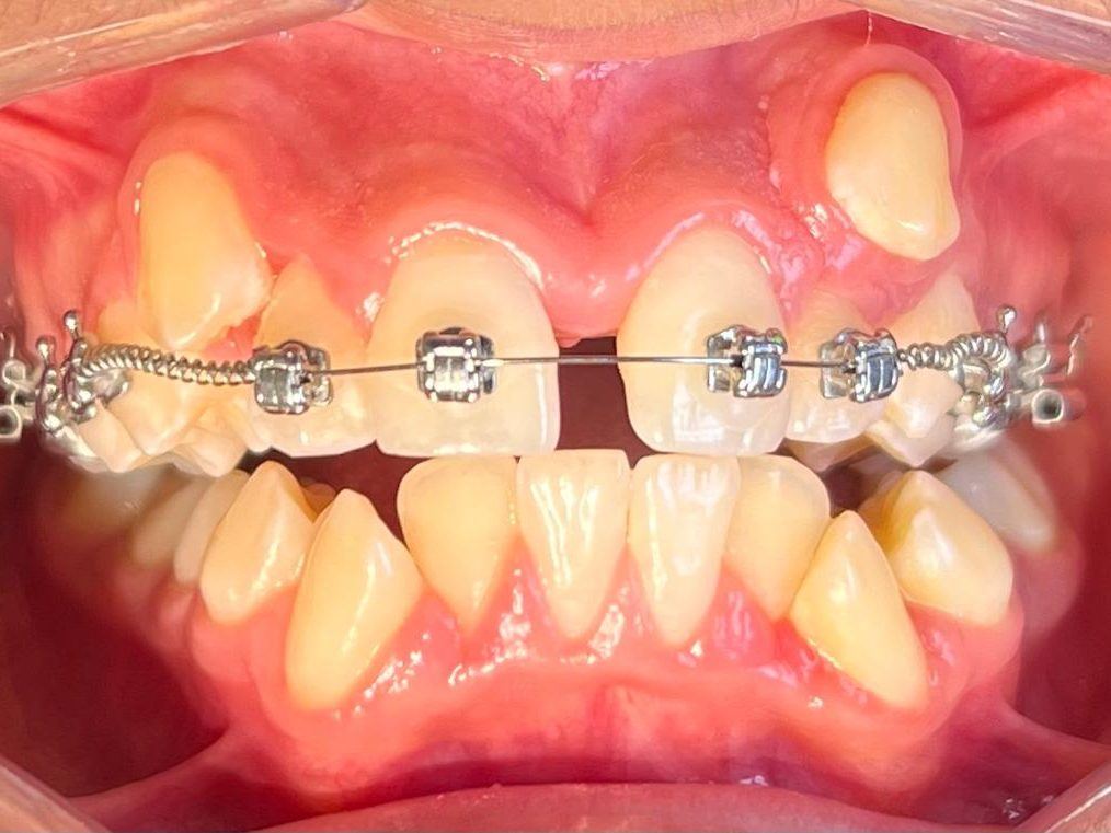 Orthodontie à Tétouan, Centre Dentaire El Attabi